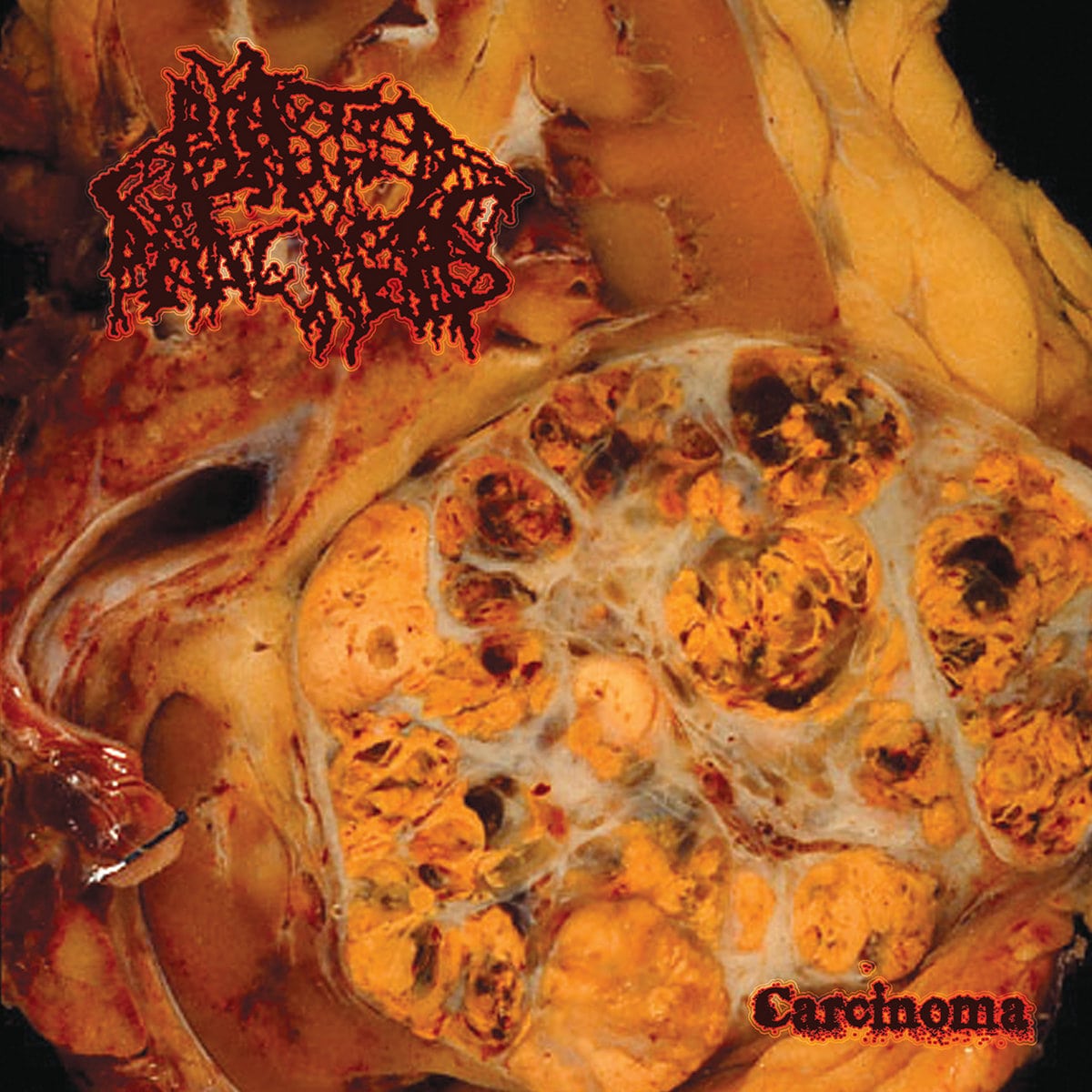 Blasted Pancreas – Carcinoma CD -min